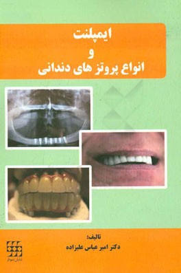 ایمپلنت و انواع پروتزهای دندانی